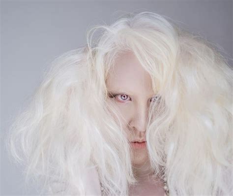 Do Albinos Have White Hair