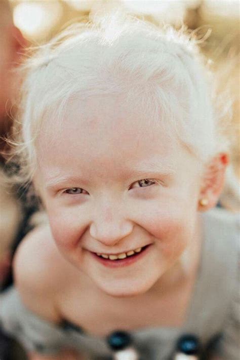 Do Albinos Have White Eyes